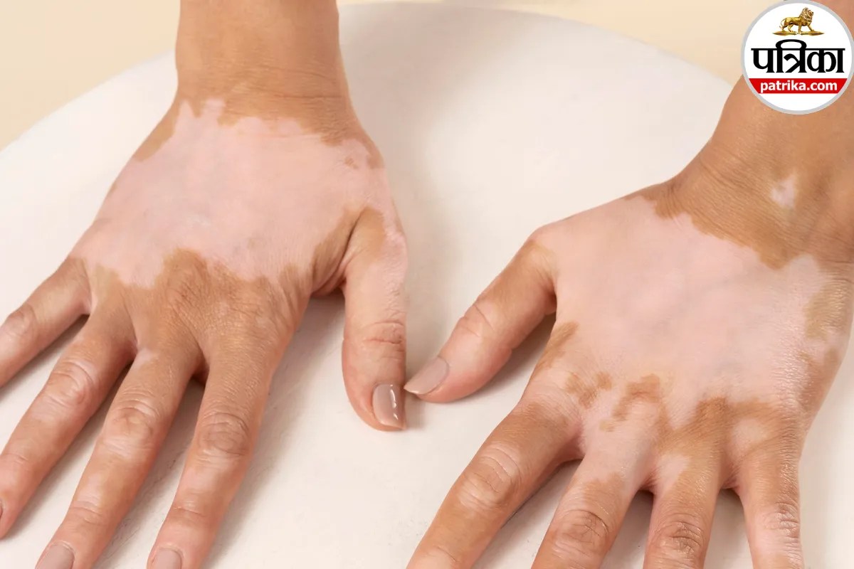 Idiopathic Guttate Hypomelanosis: त्वचा पर दिखने लगे छोटे-छोटे सफेद दाग, हो सकता है इडियोपैथिक गुटेट जानें लक्षण और कारण