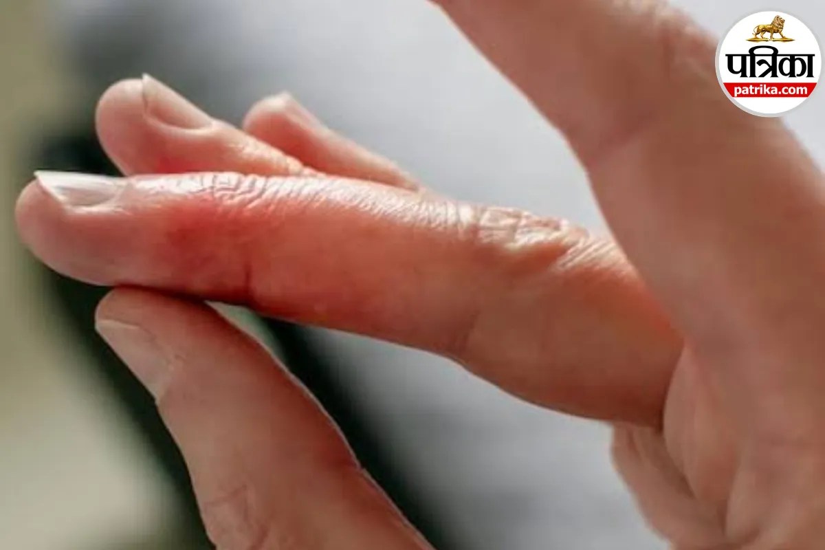 Mallet Finger: चोट के बाद उंगली का सिरा झुक गया है? एनएचएस ने बताया हो सकता है मैलेट फिंगर