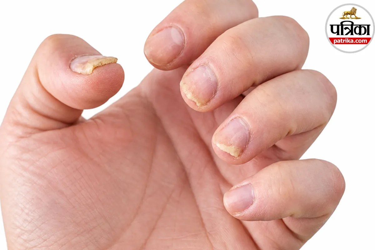 Nail Psoriasis: बिना चोट के नाखून खराब होने लगे तो ध्यान दें, नेल सोरायसिस हो सकती है वजह, AAD से जानें लक्षण