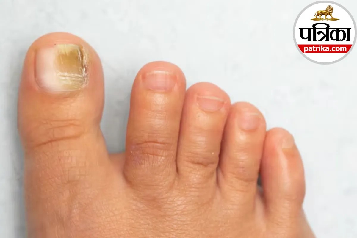 Pallor Skin: चेहरा, होंठ और नाखून पड़ने लगे सफेद और पीला ? क्लीवलैंड क्लिनिक से जानें जानें पैलोर के कारण और संकेत