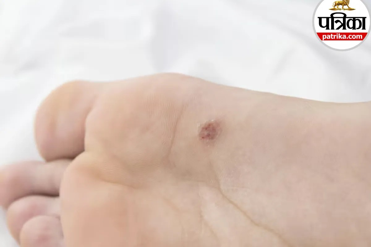 Plantar Warts: चलते समय तलवों में दर्द और त्वचा पर उभरी गांठ, जानें प्लांटर वार्ट्स के लक्षण