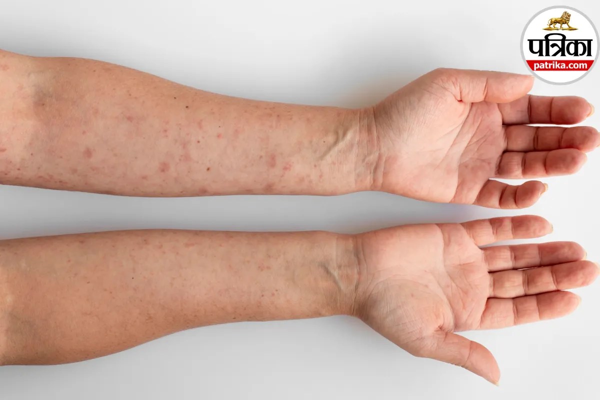Variola Virus क्या है? जानें तेज बुखार से शरीर पर निकलने वाले दानों तक इसके लक्षण और कारण