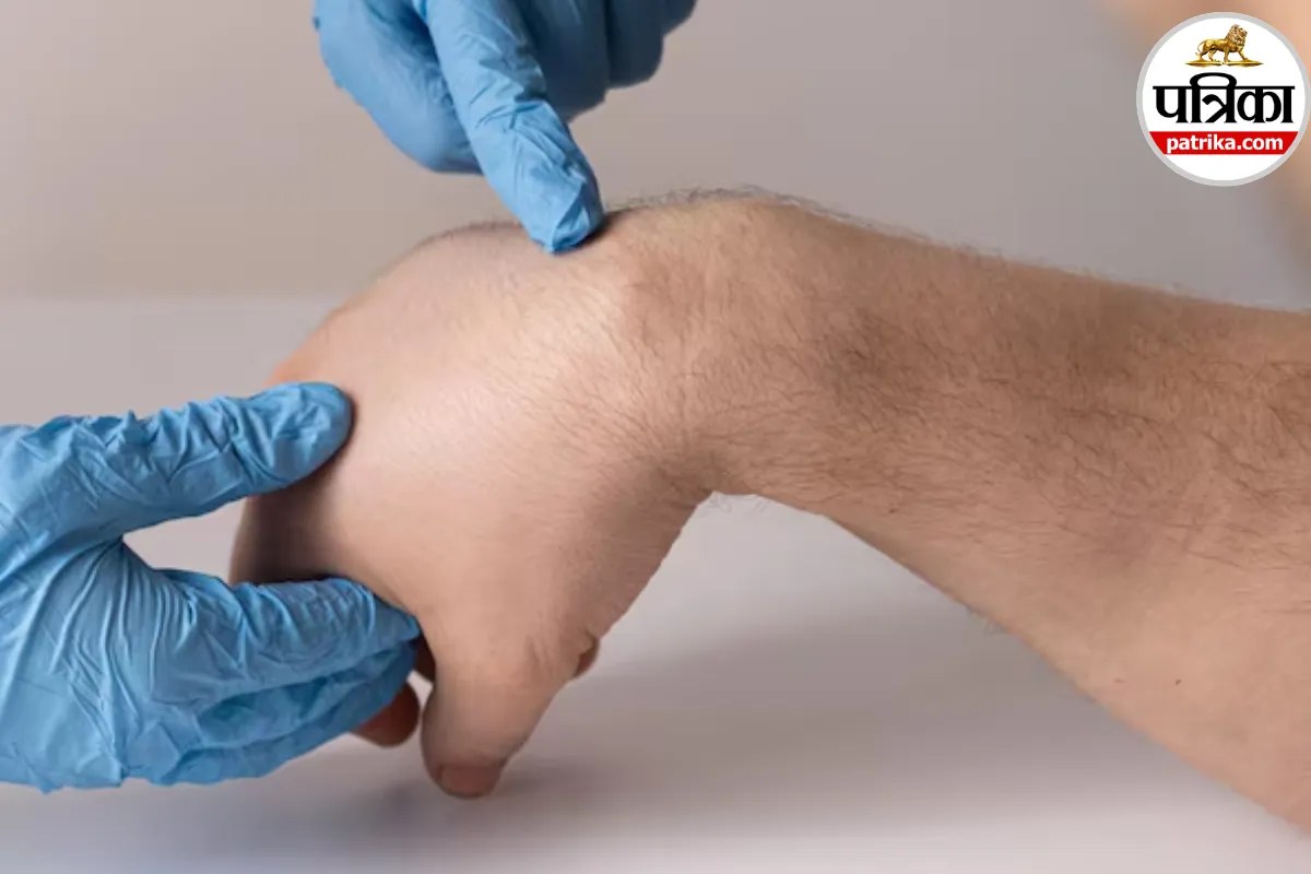 कलाई पर अचानक बन गई नरम गांठ और दबाने पर दर्द? हो सकता है Ganglion Cyst