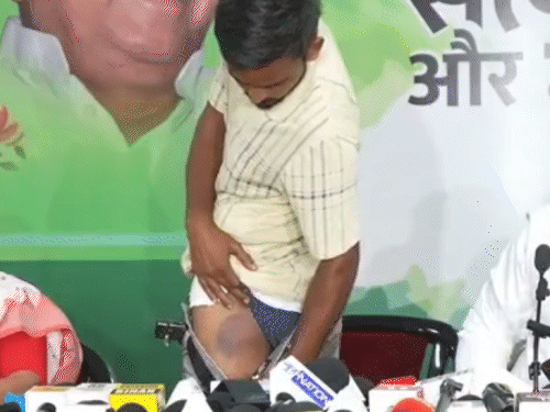 तेजस्वी की PC में यूट्यूबर ने पेंट उतारकर दिखाए घाव:कहा- मंत्री के कहने पर पुलिस ने उठाया, 50 डंडे मारे; लखेंद्र पासवान बोले- ये झूठ की राजनीति
