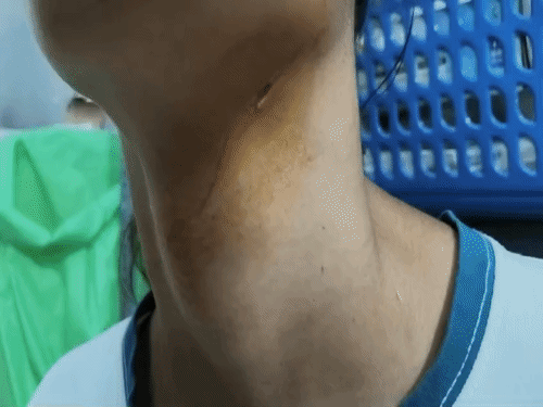 लुधियाना में कंप्यूटर ऑपरेटर के गले में फंसी चाइना डोर:गर्दन पर लगा 10 इंच लंबा कट,काम से घर लौट रही थी युवती