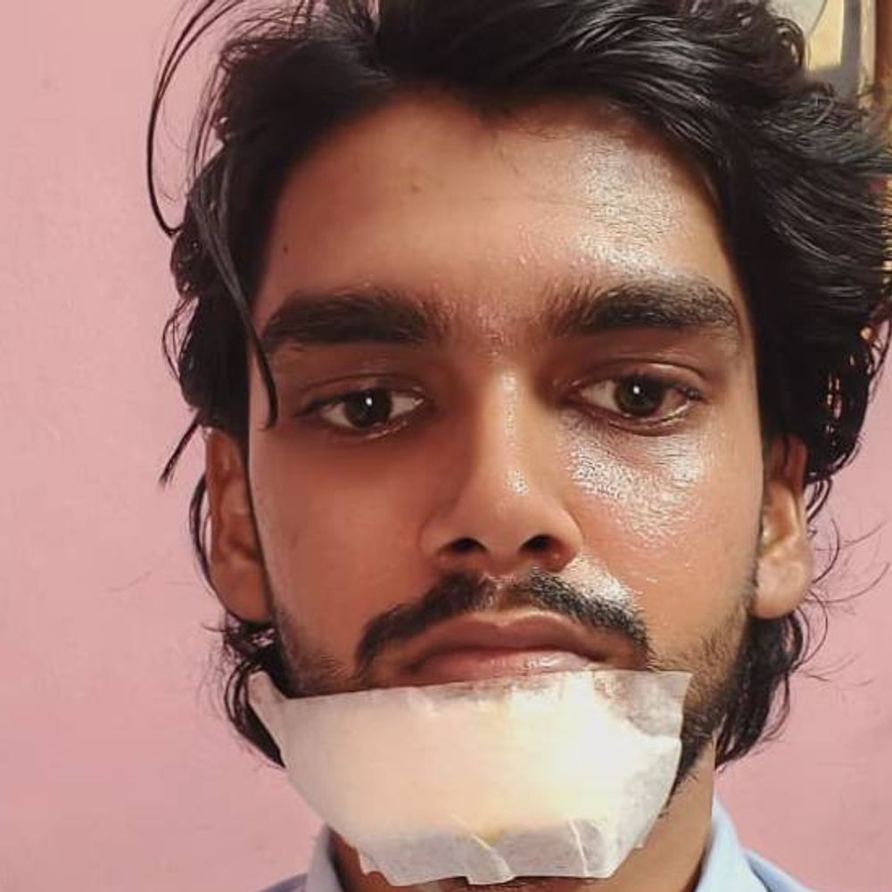 गोरखपुर में चाइनीज मांझा में उलझ गया छात्र:कट गया जबड़ा, डॉक्टर ने लगाए 12 टांके, कॉलेज से घर जाते समय हादसा हुआ