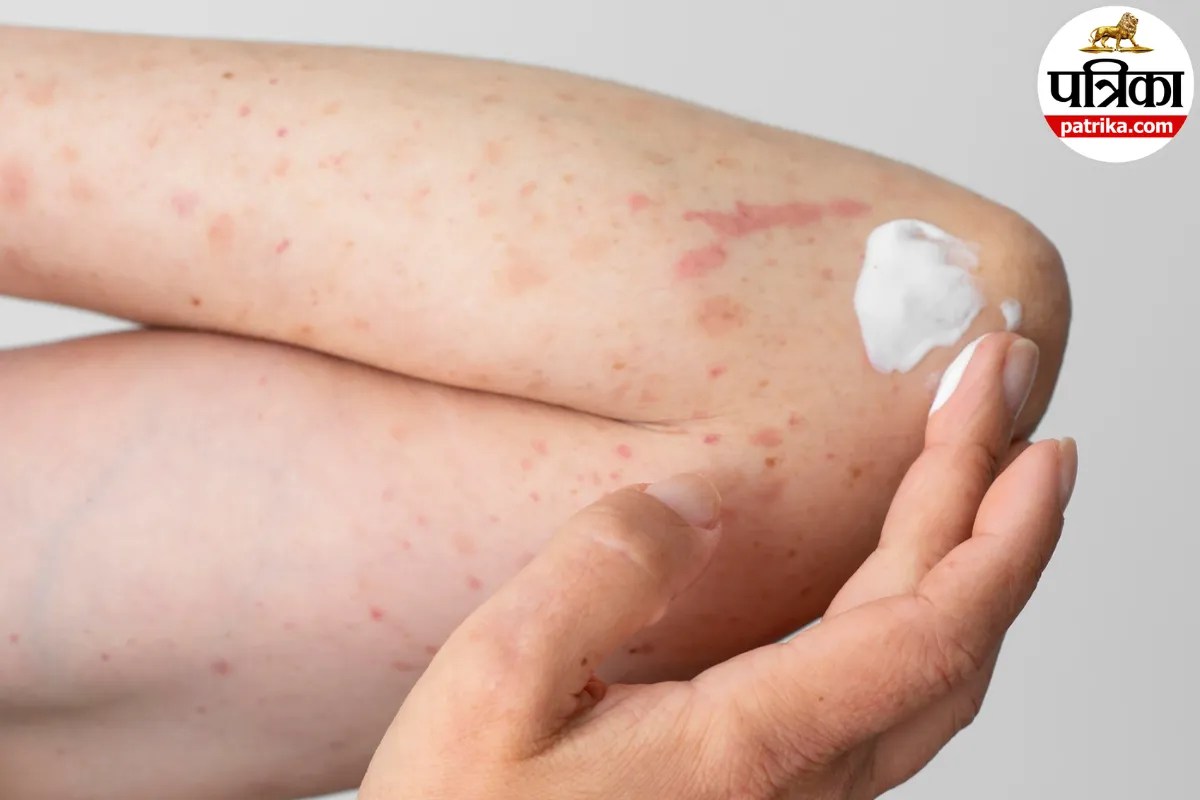 Bug Bites: मधुमक्खी, चींटी या मकड़ी के काटने पर क्या करें? क्लीवलैंड क्लिनिक से जानें प्राथमिक उपचार और जरूरी सावधानियां