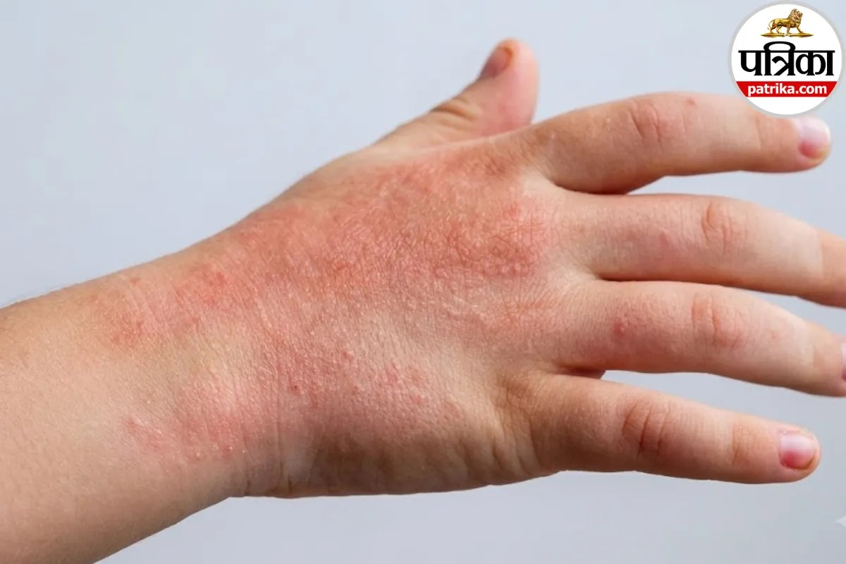 Discoid Eczema: शरीर पर सिक्के के आकार के लाल धब्बे और तेज खुजली, NHS ने बताई डिस्कॉयड एक्जिमा की पहचान