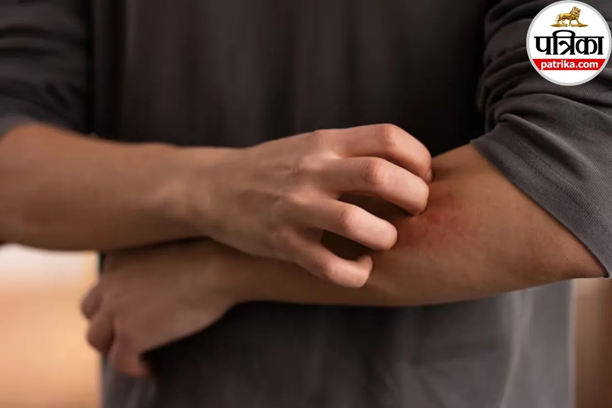 बिना चोट के त्वचा लाल हो जाती है, साइंस डायरेक्ट से जानें Erythema क्या है और इसके कारण