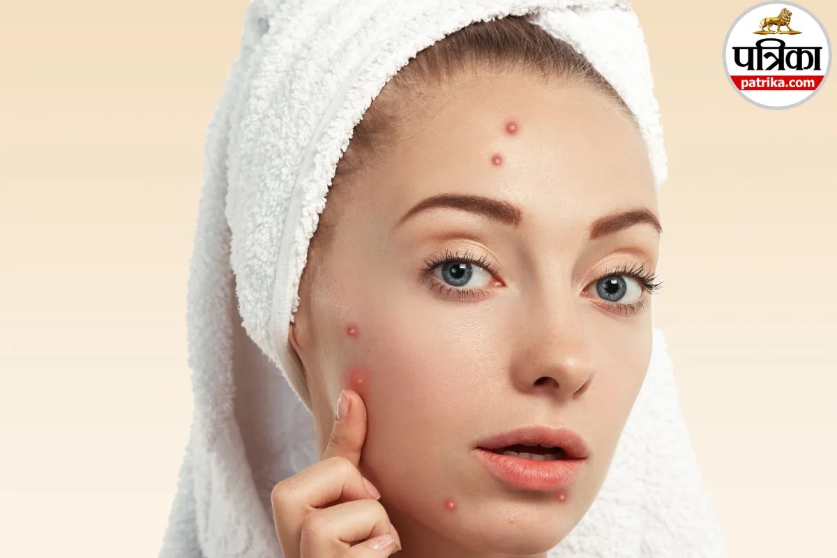 Facial Yeast Infection: मुंहासे नहीं, चेहरे पर फंगल इंफेक्शन का संकेत हो सकते हैं ये छोटे-छोटे दाने, क्लीवलैंड क्लिनिक से जानें लक्षण