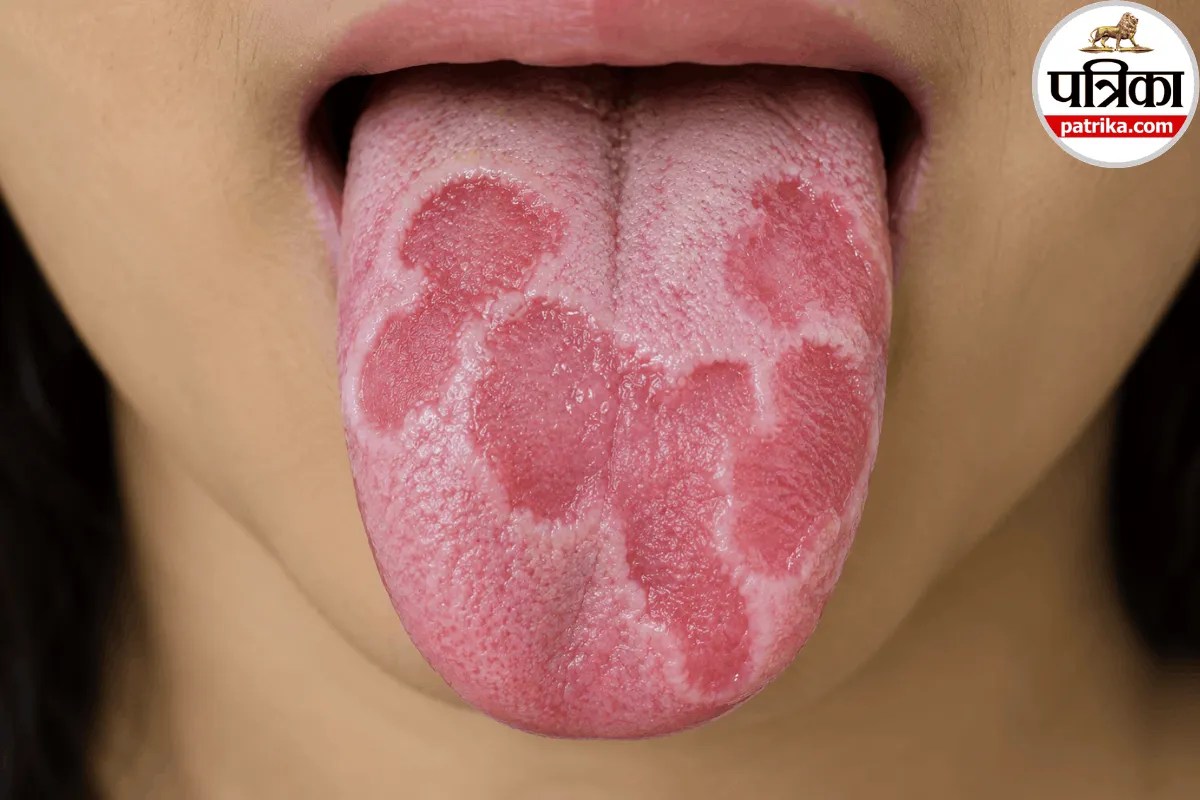 Geographic Tongue Cause: जीभ पर उभर रहे हैं लाल धब्बे, जगह और आकार भी बदल रहे हैं, मेयो क्लिनिक से जानें Geographic Tongue की वजह