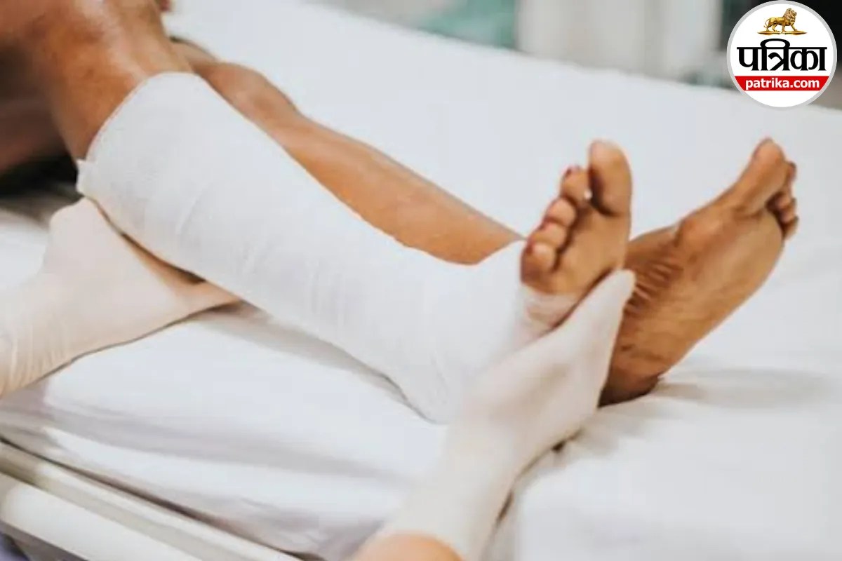 Oblique Fracture: हड्डी टूटने के बाद कब लगता है प्लास्टर और कब होती है सर्जरी? जानें ऑब्लिक फ्रैक्चर के बारें में