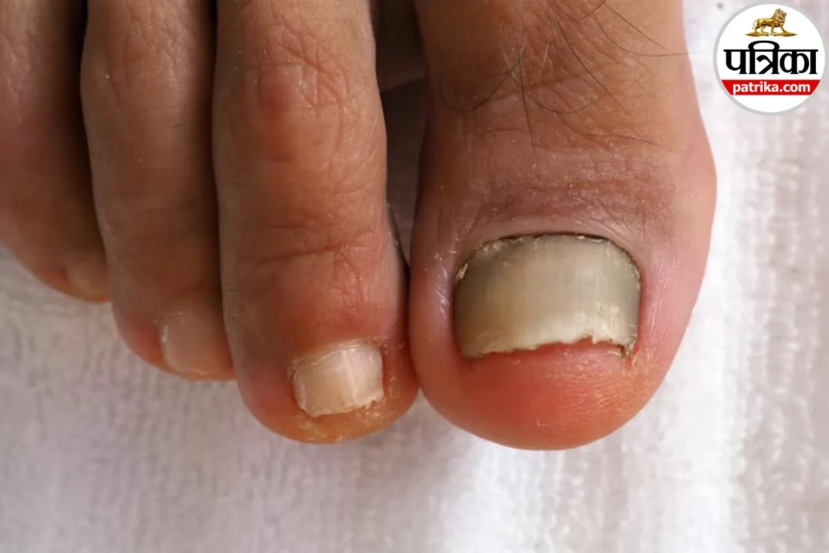 नाखून त्वचा से अलग क्यों होने लगता है? क्लीवलैंड क्लिनिक से जानें Onycholysis के कारण और लक्षण