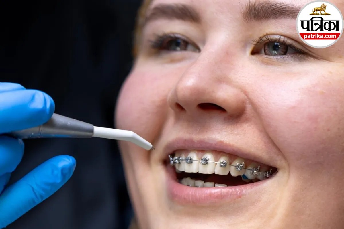 बच्चों के टेढ़े-मेढ़े दांतों को ठीक करने में मदद करता है Palatal Expander, जानें कैसे और कब लगाया जाता है