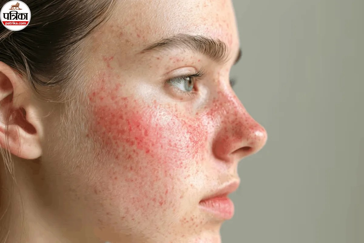 चेहरे पर बार-बार लालिमा और दाने निकलना पिंपल नहीं, हो सकते हैं Rosacea, Cleveland Clinic से जानें बचाव के तरीके