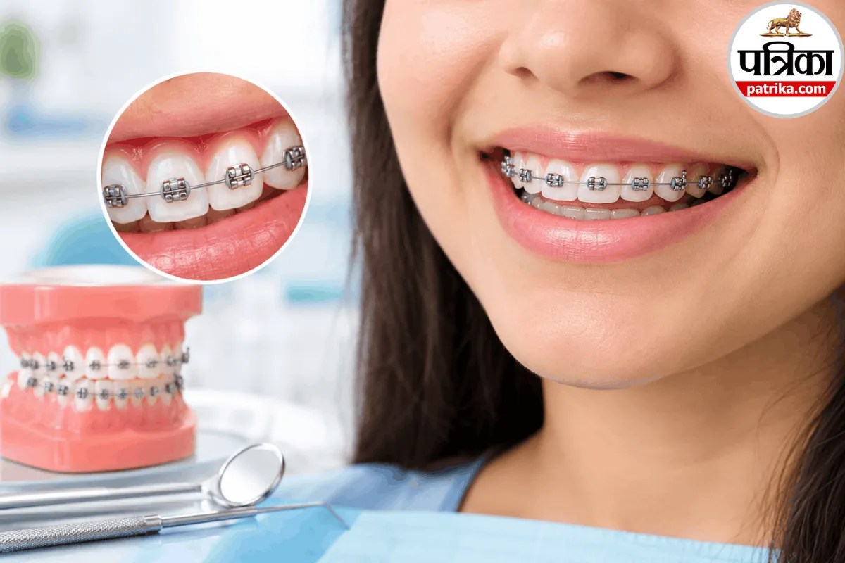 Teeth Braces: टेढ़े-मेढ़े दांतों को सीधा करने के लिए कैसे काम करते हैं ब्रेसेज? AAO से जानें इसको लगवाने से पहले जरुरी बातेें