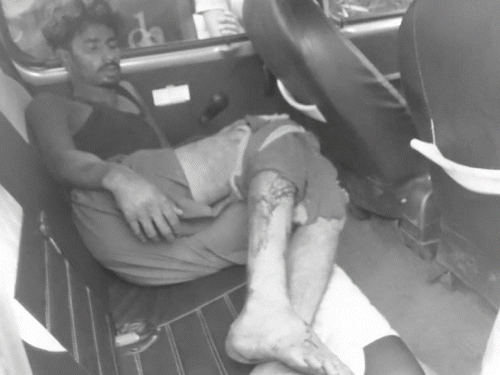 पाकुड़ में दो हाईवा की सीधी टक्कर, चालक गंभीर:कोयला लदे हाईवा से खाली हाईवा भिड़ा, केबिन में फंसे चालक को जेसीबी से निकाला