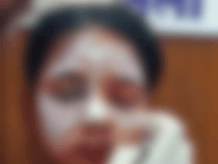 पुलिसकर्मी की बेटी पर एसिड अटैक:बालोद में लाइब्रेरी से लौट रही थी, शरीर का दाहिना हिस्सा और आंख-चेहरा झुलसा, 2 आरोपी पकड़ाए