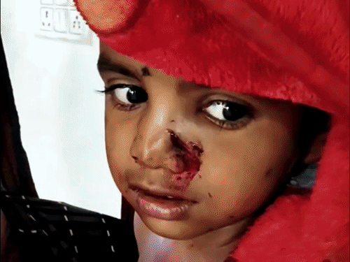 कुत्ते के हमले में 4 साल की बच्ची घायल:चेहरे-गले पर गहरे घाव, गांव में इलाज नहीं, 115 किमी दूर जिला अस्पताल पहुंचा परिवार; RIG लगा